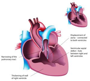 Congenital heart disease: Tetralogy of Fallot