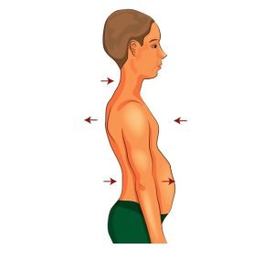 A boy with signs of rickets