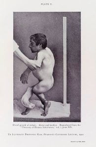 Photograph showing male dwarf, the result of rickets (vitamin D)