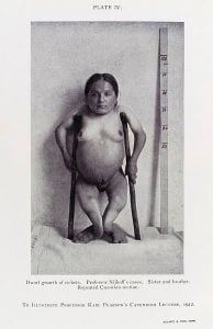 Photograph showing female dwarf, the result of rickets (vitamin D)