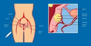 Uterine Fibroids Embolization