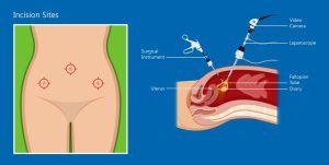 Laparoscopic hysterectomy