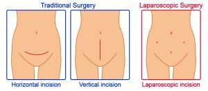 Uterine fibroids surgery