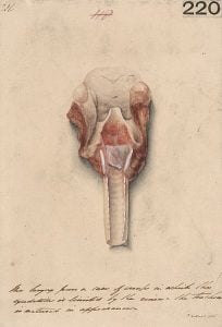 Larynx from a patient of croup