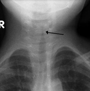 X-ray of the neck in a child with croup