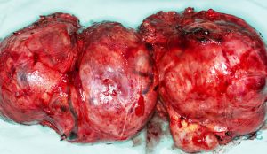 Close-up view of a large thyroid gland removed after the operation