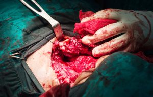 Total thyroidectomy surgery