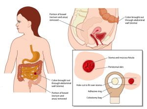 Colostomy: Details of colostomy bag and stoma to treat diverticulitis