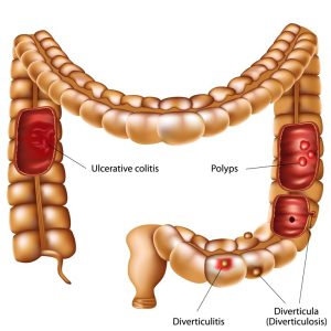 Colon diseases image