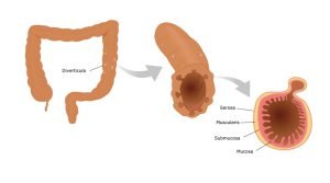 Gastrointestinal disease image: Diverticula in the large intestine