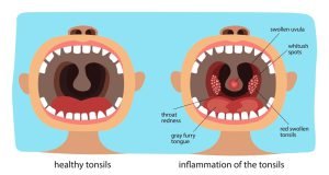 Healthy throat vs throat with inflammation
