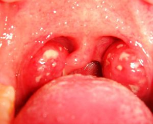 Tonsilitis image
