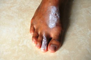 Scabies on foot