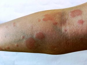 Lupus rashes on hand