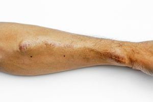Arm of hemodialysis blood vessel for renal insufficiency patient