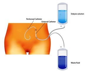 Peritoneal dialysis procedure