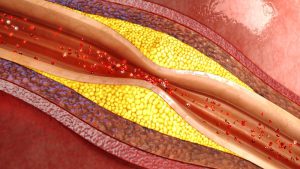 Plaque in blood vessels