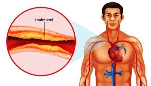 The process of arteriosclerosis