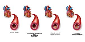 Heart muscle damaged due to blood clot causes angina