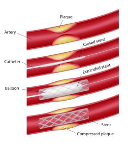 Atherosclerosis