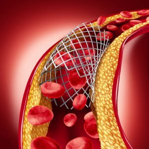 Stent implant concept as a heart disease treatment - 3D illustration