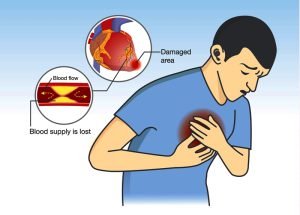 Man have early symptoms of heart attack in the form of angina