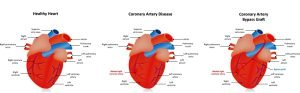 Coronary Artery Bypass Graft (CABG) for treating angina