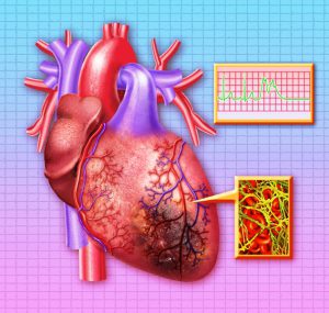 An illustration of heart attack with blood clot and damaged heart