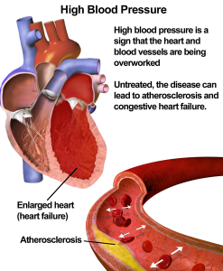 Hypertension (High Blood Pressure) and enlarged heart