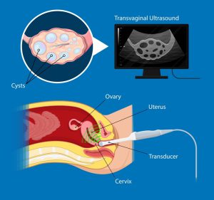 Transvaginal ultrasound