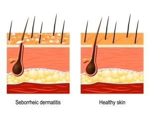Healthy skin vs skin with dandruff