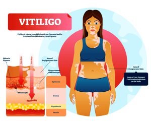 Vitiligo basics