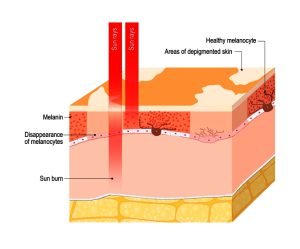 How do vitiligo symptoms develop?