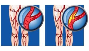 Peripheral arterial disease in lower limb