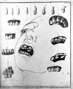 Supernumerary teeth