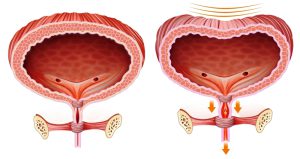 Comparative anatomical illustration of the bladder with problems