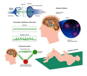 Epileptic seizures