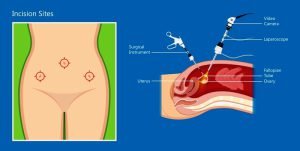 Laparoscopic hysterectomy