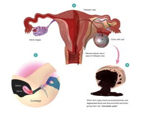 Ovarian endometriosis