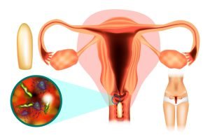 Treatment of female genital infections (vaginitis)