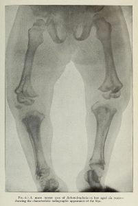 X-ray scan image of a boy with short legs