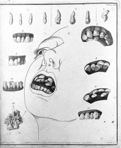 Crooked teeth: A symptom of Achondroplasia