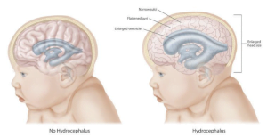 Effect of hydrocephalus on the brain