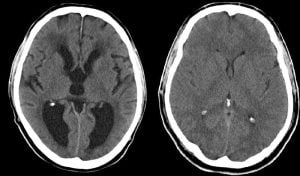 Head Scan for hydrocephalus