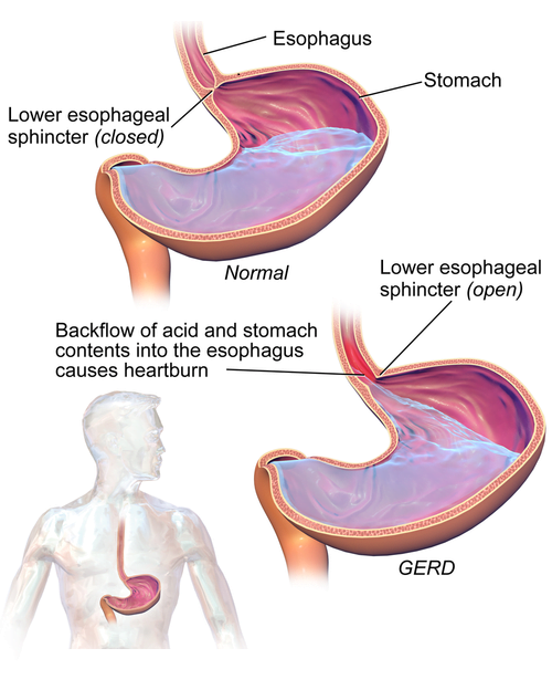 Gastroesophageal reflux disease