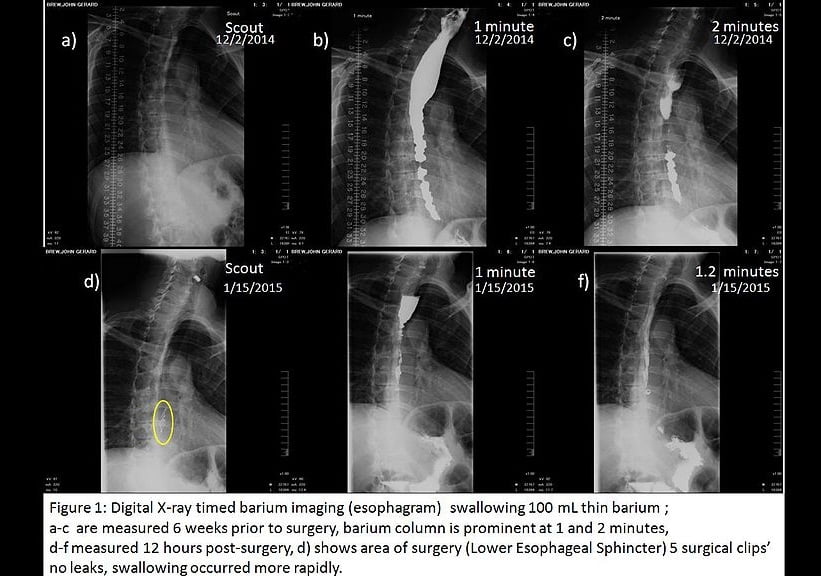 Barium-Swallow: Diagnosis of achalasia