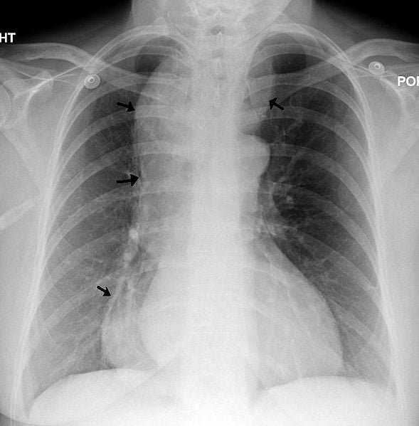 Radiography for Achalasia