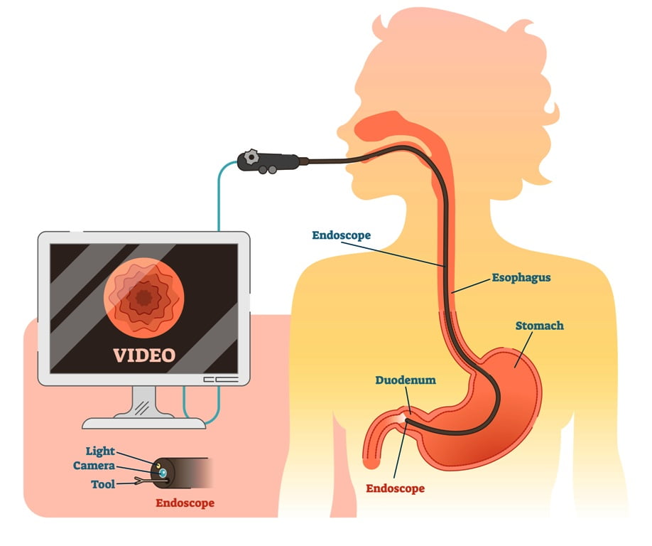 Endoscopic monitoring of esophagus and stomach