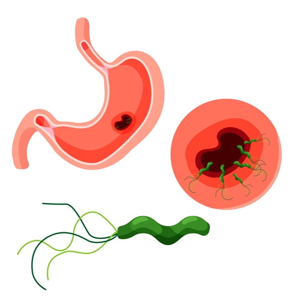 Esophagus anatomy and helicobacter pylori
