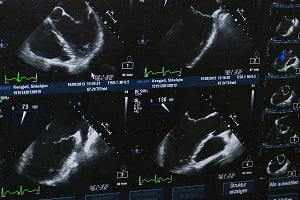 HCC Liver Ultrasound